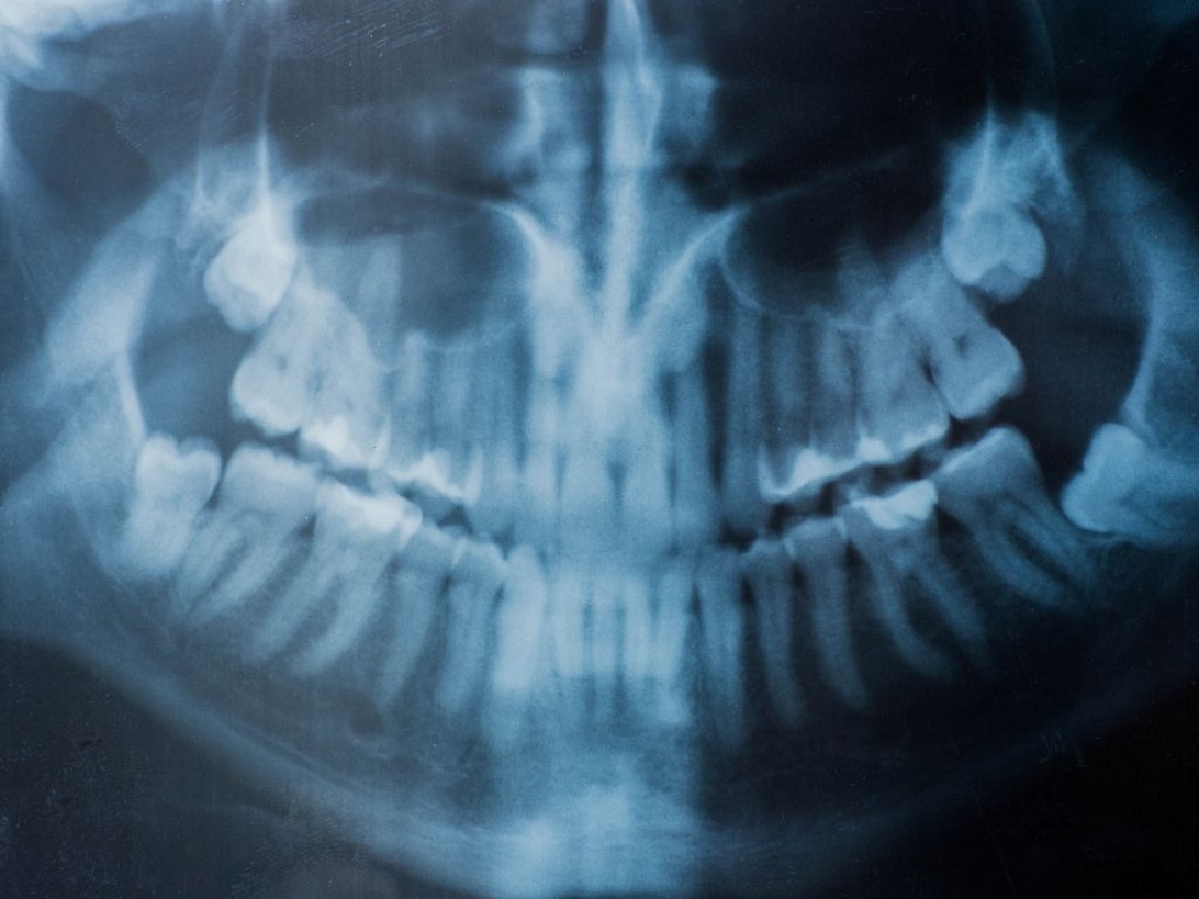Et panoramarøntgenbilde som viser hele kjevestrukturen, inkludert tenner og omkringliggende beinvev, brukt i diagnostisering av kjeveplager.